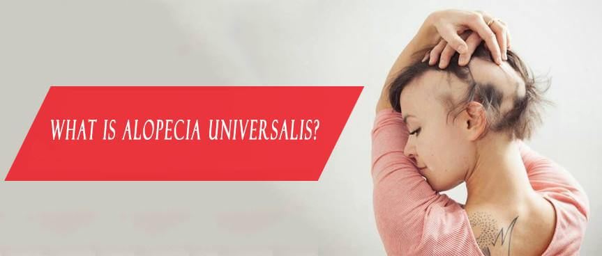 What Is Alopecia Universalis?
