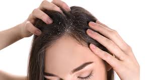 Banish Flakes for Good: Effective Strategies to Control Recurring Dandruff